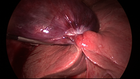 Gallbladder volvulus